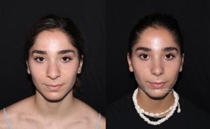  rhinoplasty new jersey patient 14 01