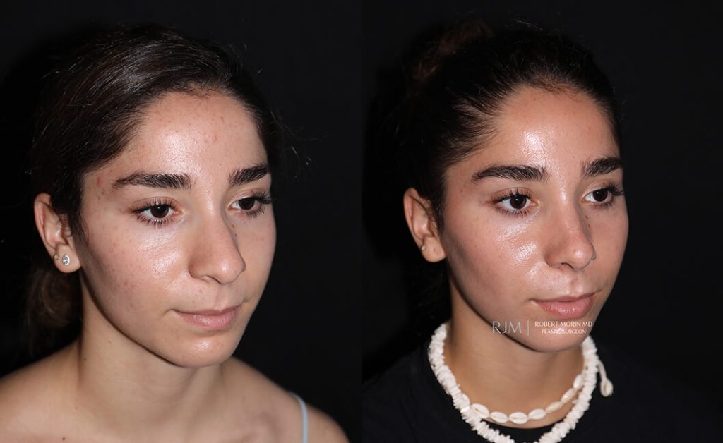  rhinoplasty new jersey patient 14 02