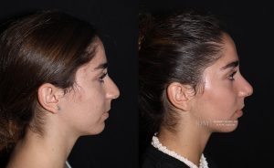  rhinoplasty new jersey patient 14 03