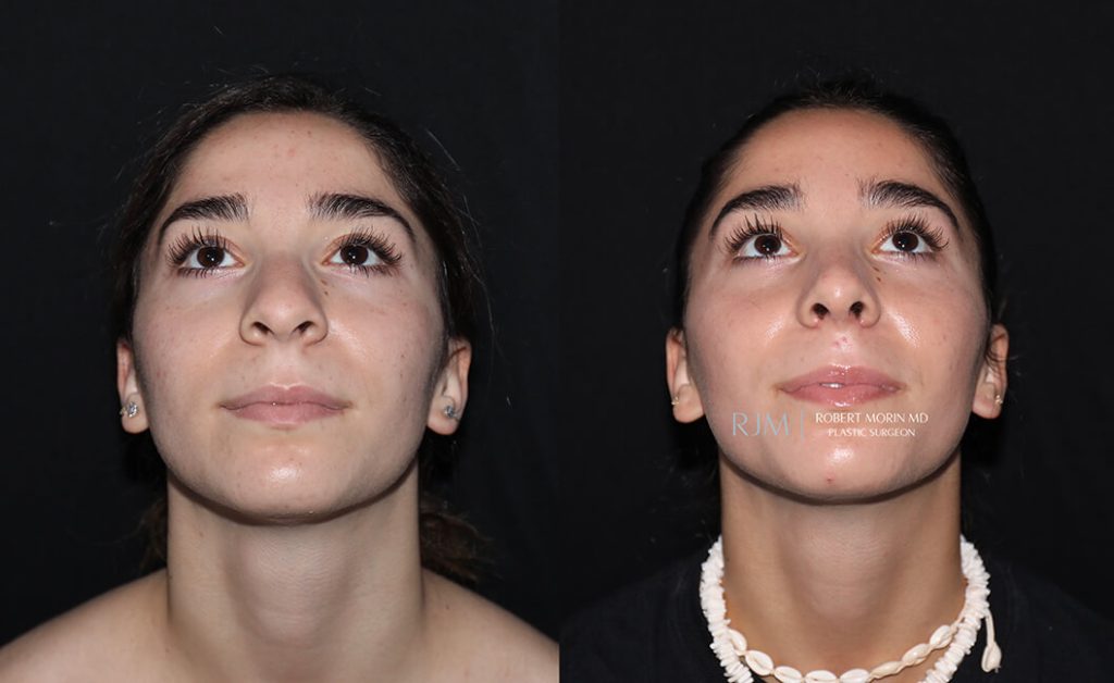  rhinoplasty new jersey patient 14 04