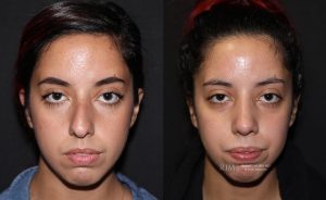  rhinoplasty new jersey patient 16 02