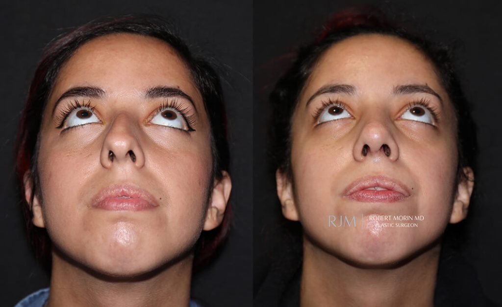  rhinoplasty new jersey patient 16 04