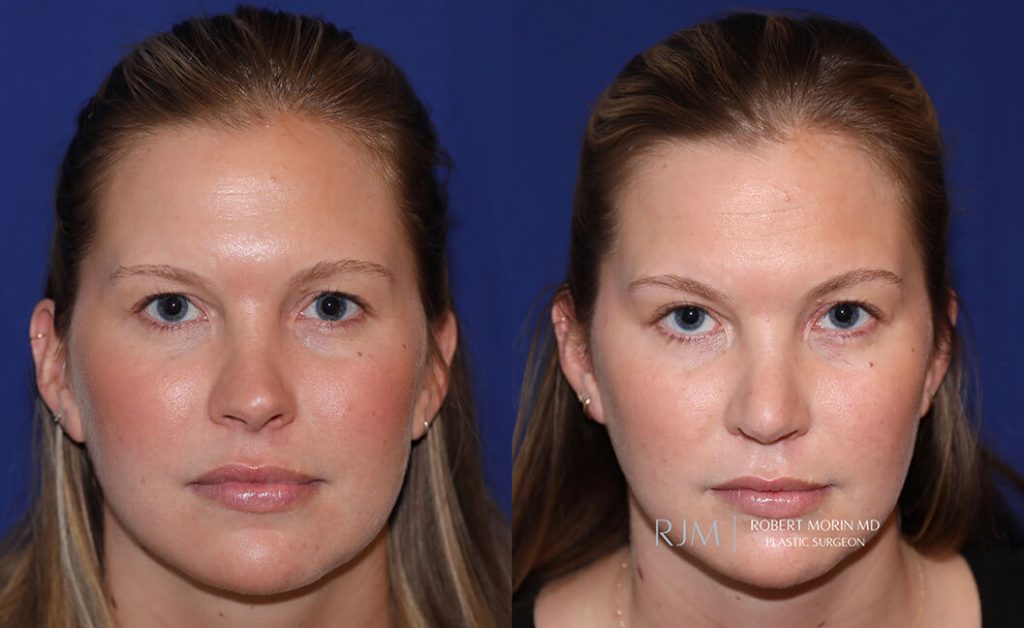  rhinoplasty new jersey patient 17 02