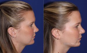  rhinoplasty new jersey patient 17 04