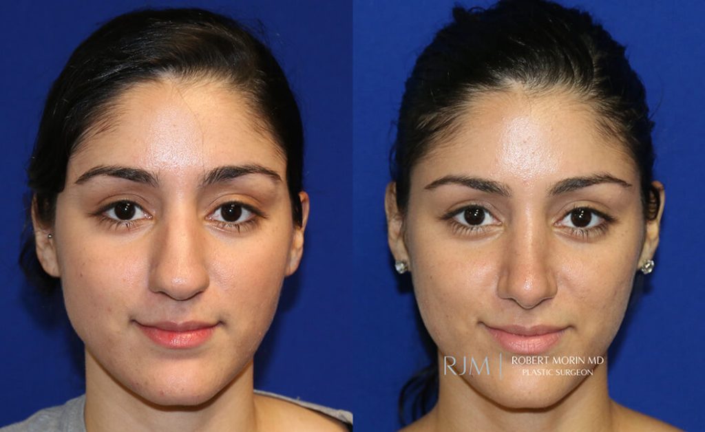  rhinoplasty new jersey patient 18 01