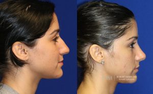  rhinoplasty new jersey patient 18 03