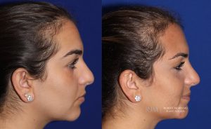  rhinoplasty new jersey patient 20 03