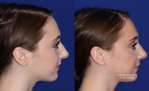  rhinoplasty new jersey patient 21 03