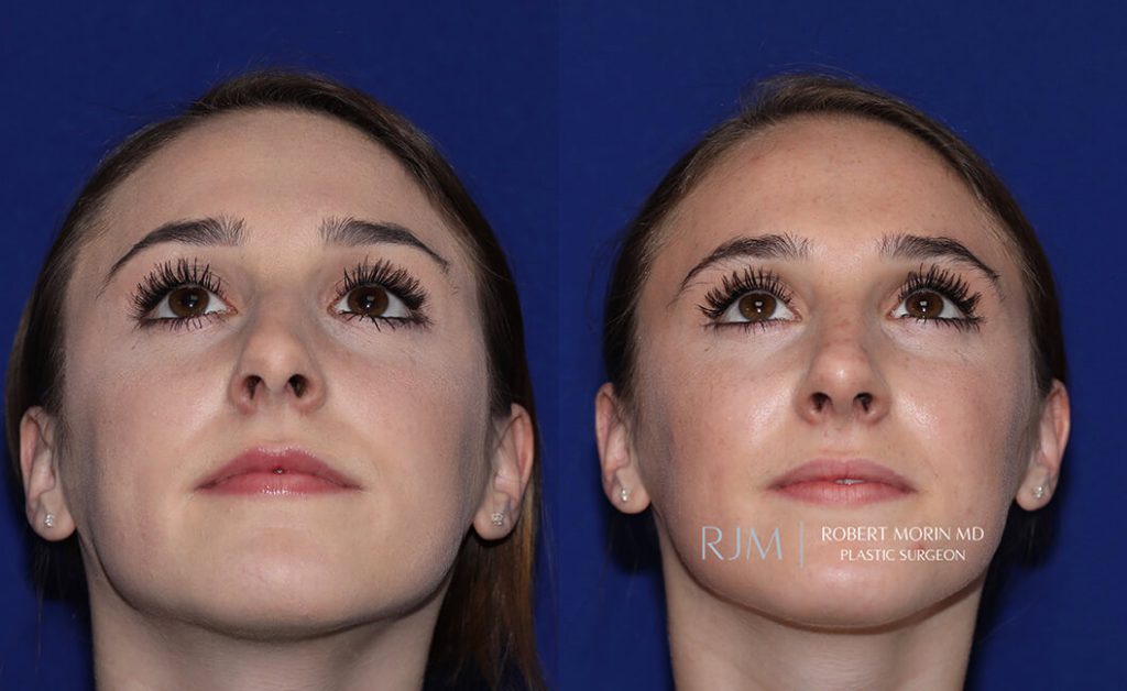  rhinoplasty new jersey patient 21 04