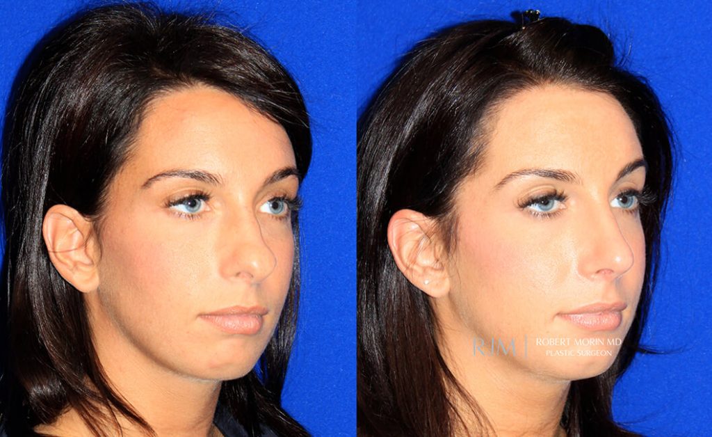  rhinoplasty new jersey patient 22 02