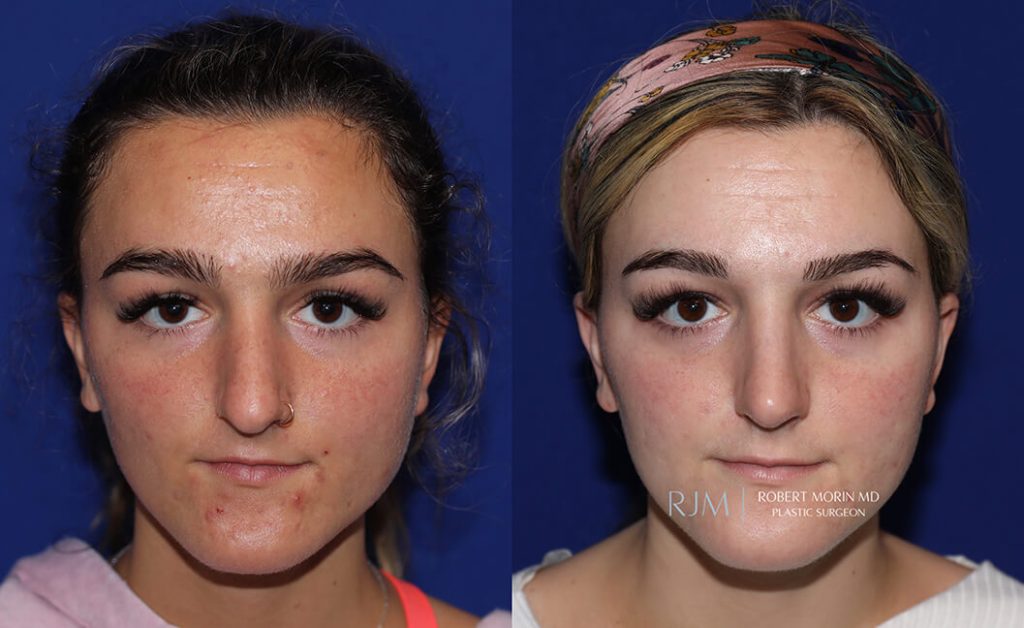  rhinoplasty new jersey patient 23 01