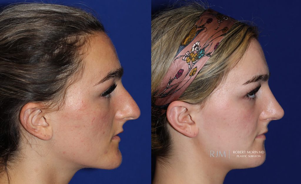  rhinoplasty new jersey patient 23 03