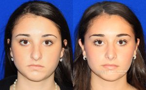  rhinoplasty new jersey patient 24 01