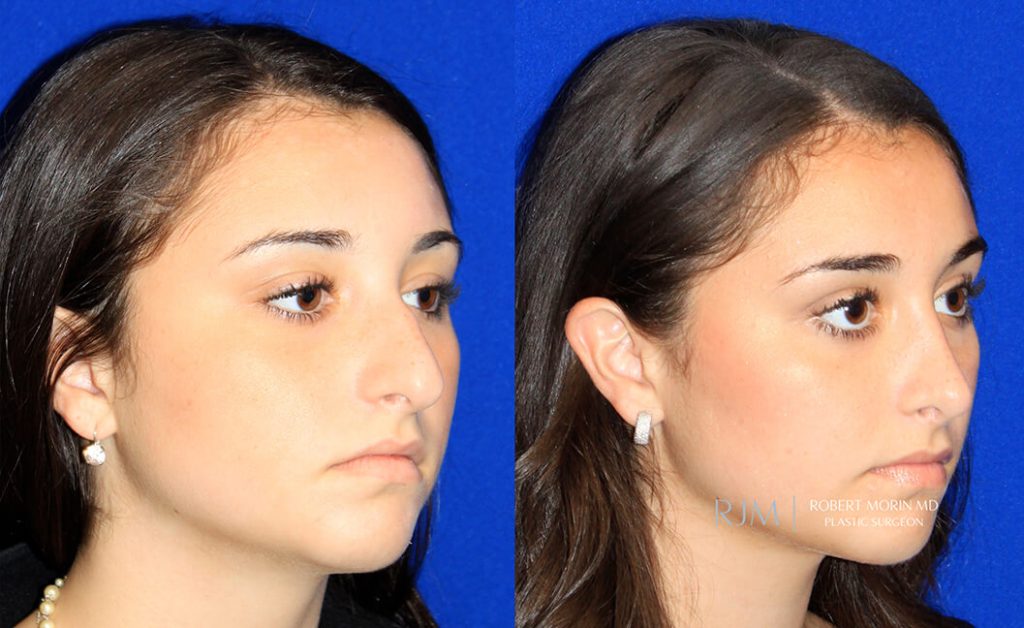  rhinoplasty new jersey patient 24 02