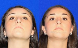  rhinoplasty new jersey patient 24 04