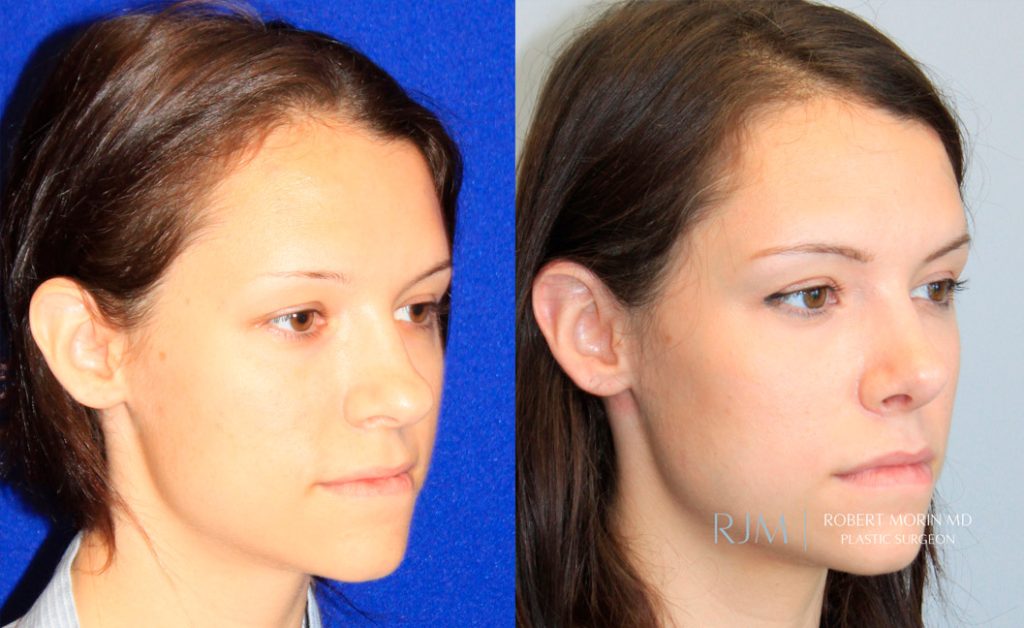  rhinoplasty new jersey patient 26 02