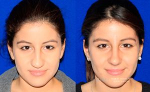  rhinoplasty new jersey patient 27 01