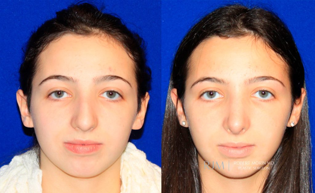  rhinoplasty new jersey patient 28 01