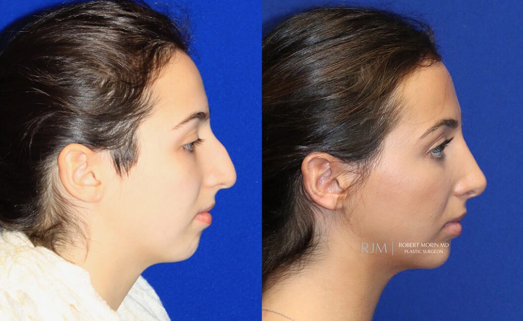  rhinoplasty new jersey patient 28 03