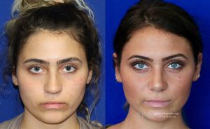  rhinoplasty new jersey patient 29 01