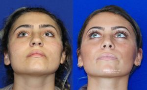  rhinoplasty new jersey patient 29 04