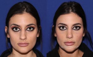  rhinoplasty new jersey patient 31 01