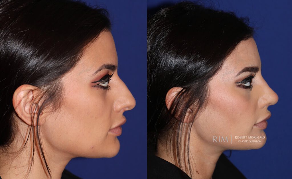  rhinoplasty new jersey patient 31 03