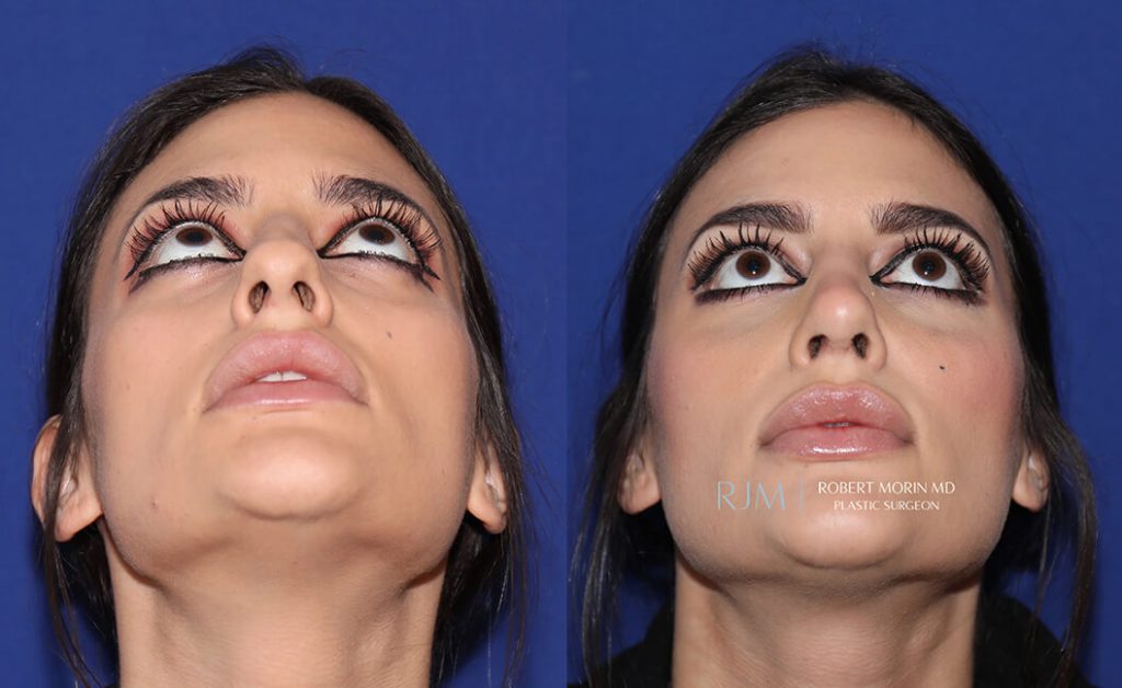  rhinoplasty new jersey patient 31 04