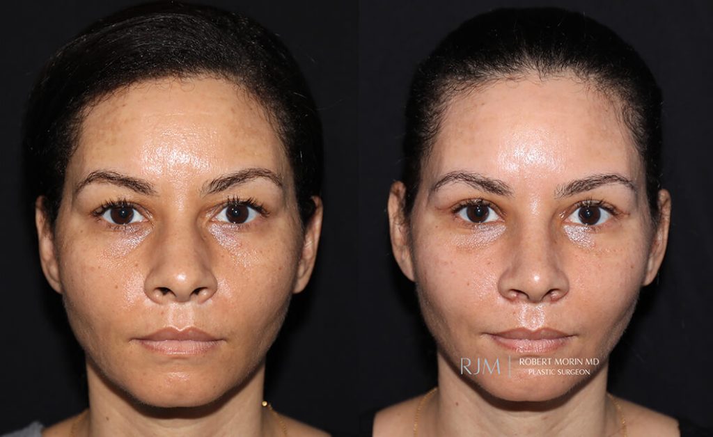  rhinoplasty new jersey patient 32 01