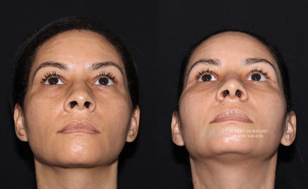  rhinoplasty new jersey patient 32 04