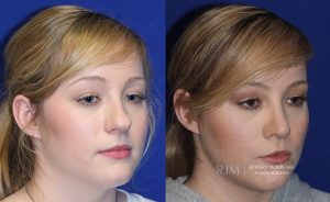  rhinoplasty new jersey patient 34 02