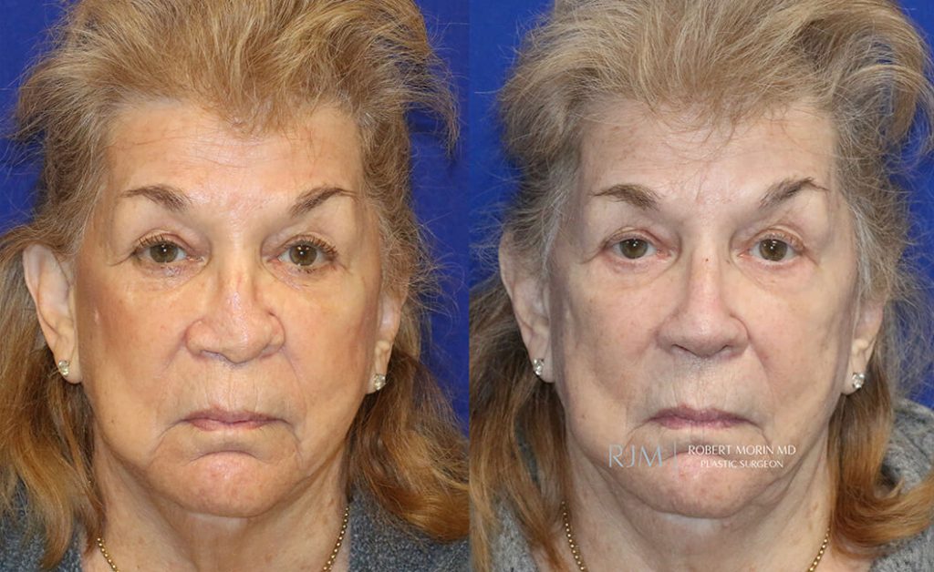  rhinoplasty new jersey patient 35 01