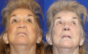  rhinoplasty new jersey patient 35 04