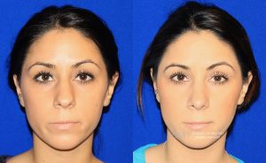  rhinoplasty new jersey patient 36 01