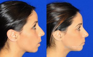  rhinoplasty new jersey patient 36 03