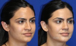  rhinoplasty new jersey patient 38 02