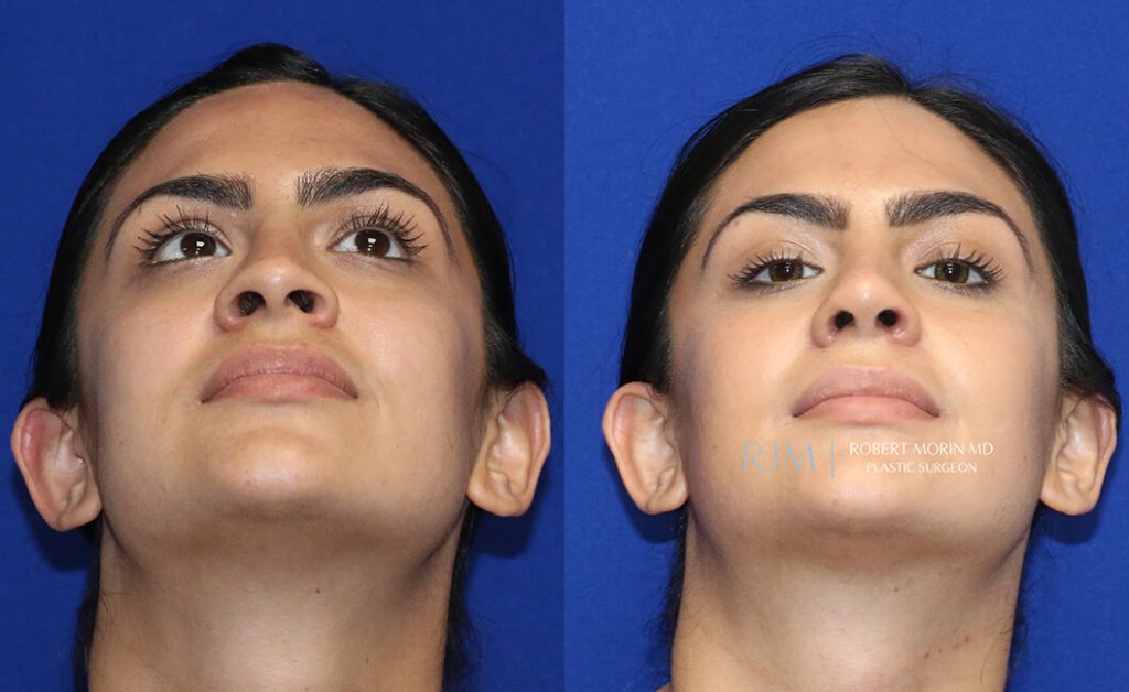  rhinoplasty new jersey patient 38 04