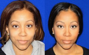  rhinoplasty new jersey patient 39 01