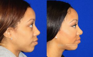  rhinoplasty new jersey patient 39 02