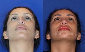  rhinoplasty new jersey patient 41 04