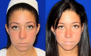  rhinoplasty new jersey patient 42 01