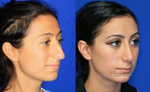  rhinoplasty new jersey patient 43 02