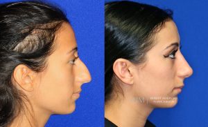  rhinoplasty new jersey patient 43 03