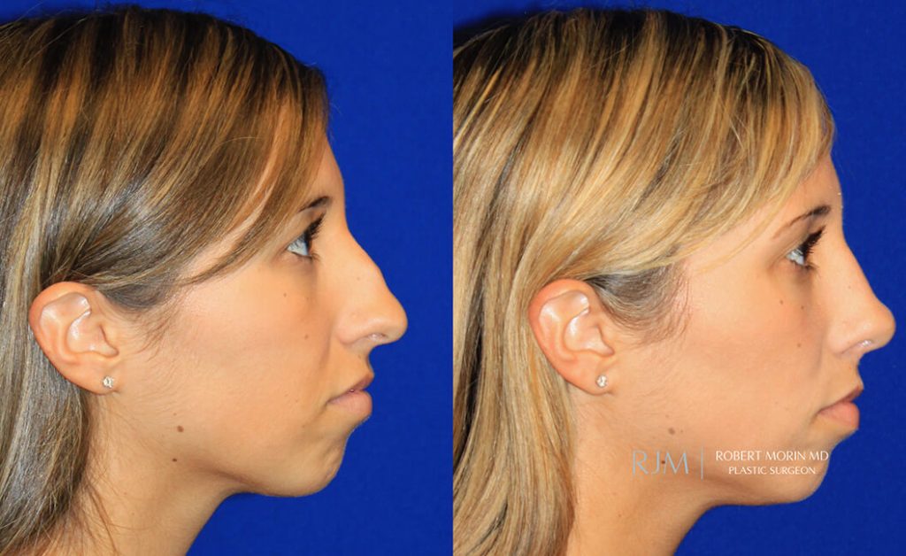  rhinoplasty new jersey patient 44 03