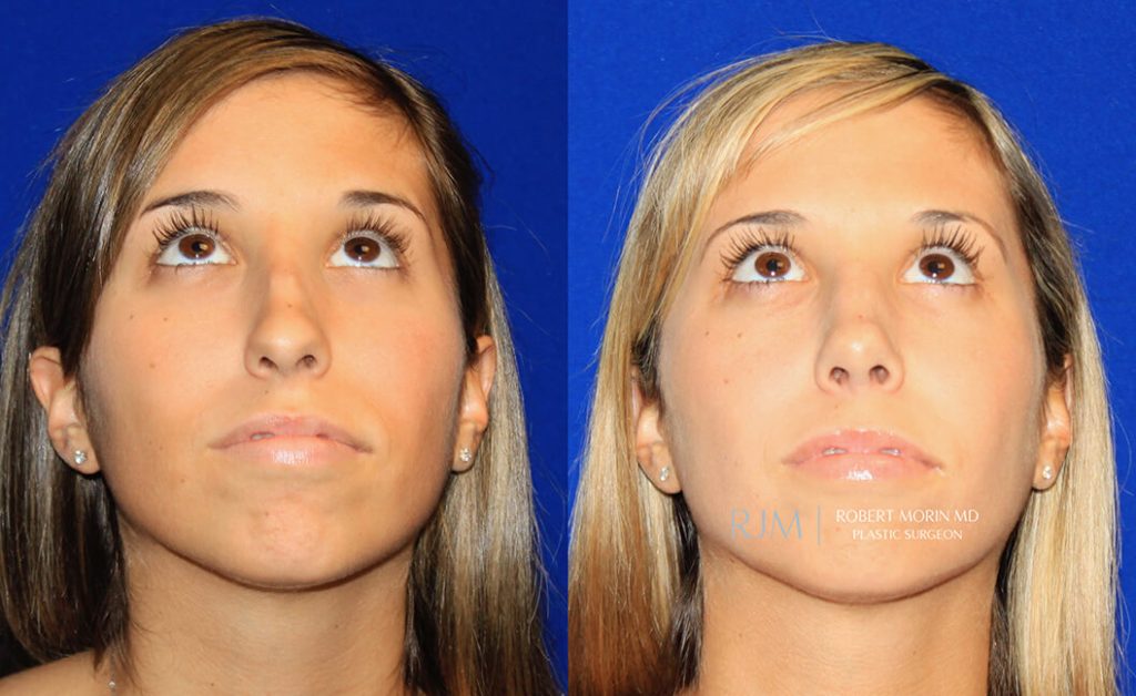  rhinoplasty new jersey patient 44 04