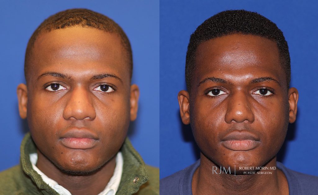  rhinoplasty new jersey patient 45 01