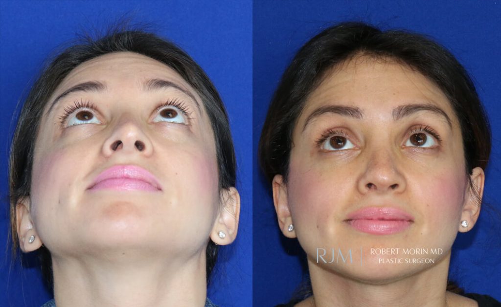  rhinoplasty new jersey patient 46 04