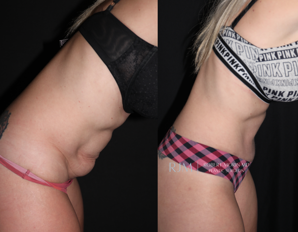  Woman's patient - body, before and after abdominoplasty treatment in New Jersey, right side view