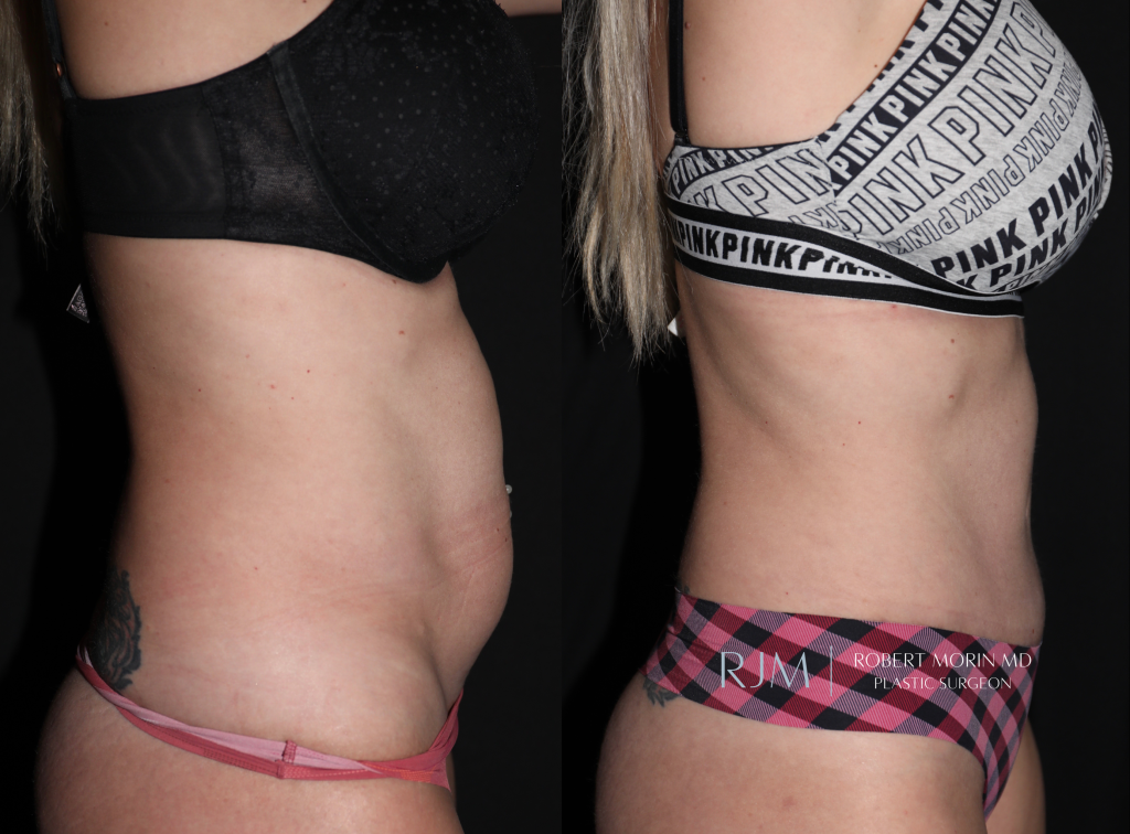  Woman's patient - body, before and after abdominoplasty treatment in New Jersey, r-side view