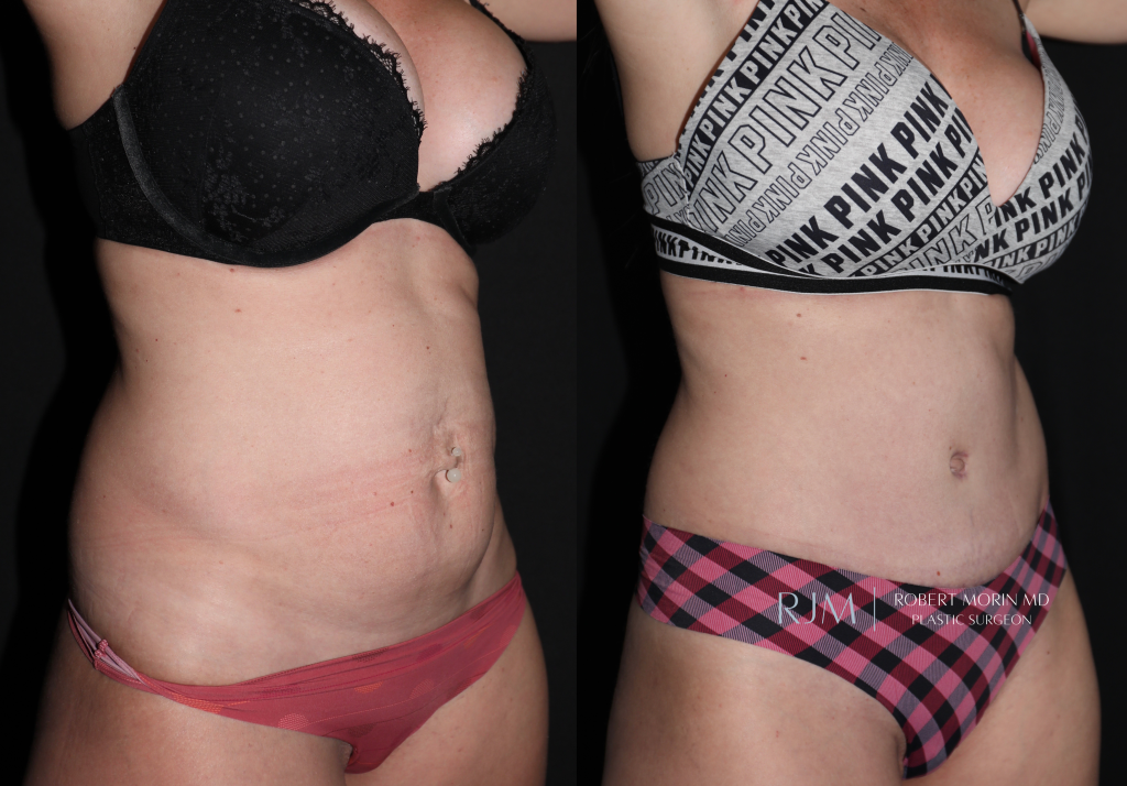  Woman's patient - body, before and after abdominoplasty treatment in New Jersey, r-side oblique view